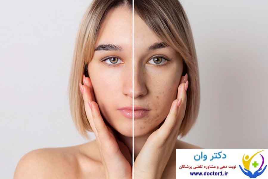 ایزوترتینوئین (راکوتان) 